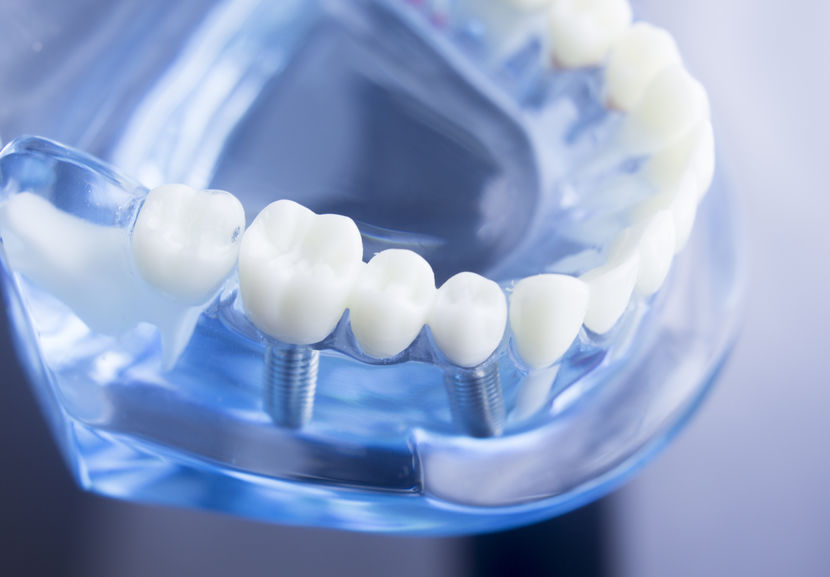 Dental Implant in Panama