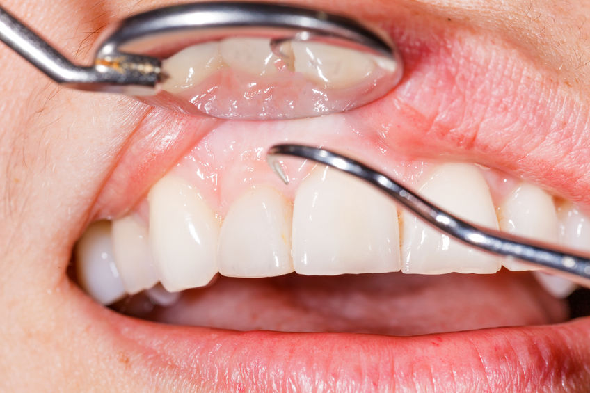 Tratamiento periodontal en Panamá