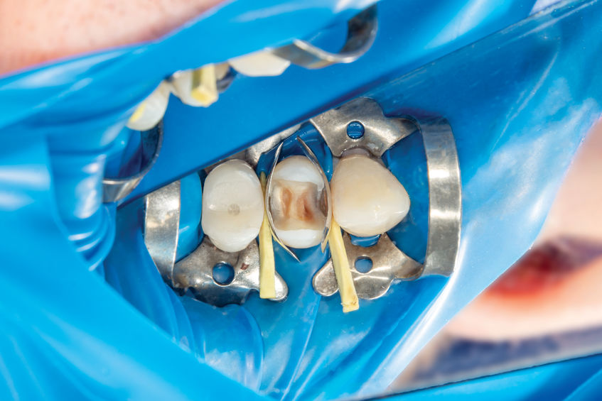White Fillings Panama
