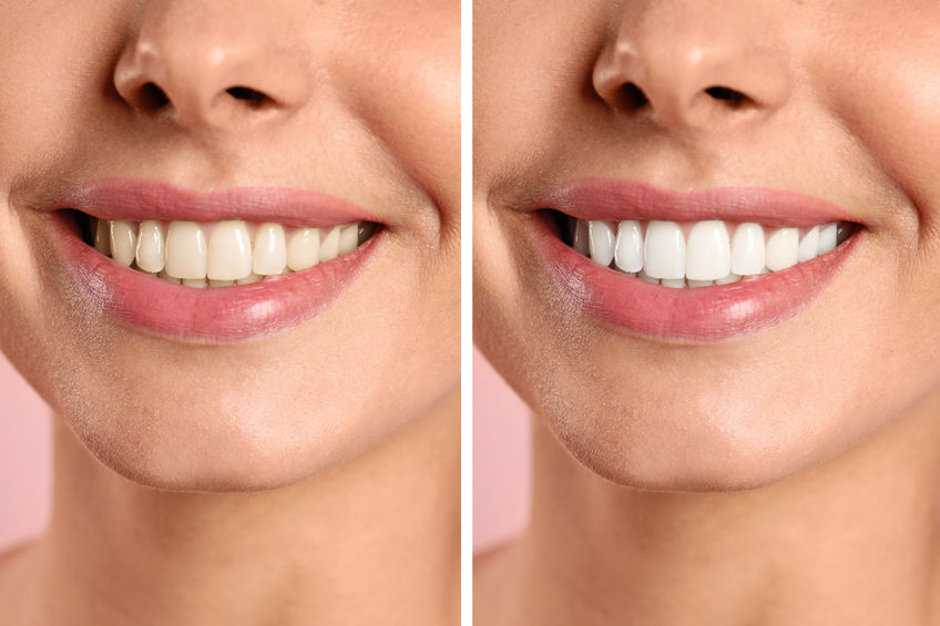 Teeth whitening and aesthetics in Panama