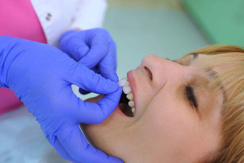 How much do dental veneers cost in Panama?