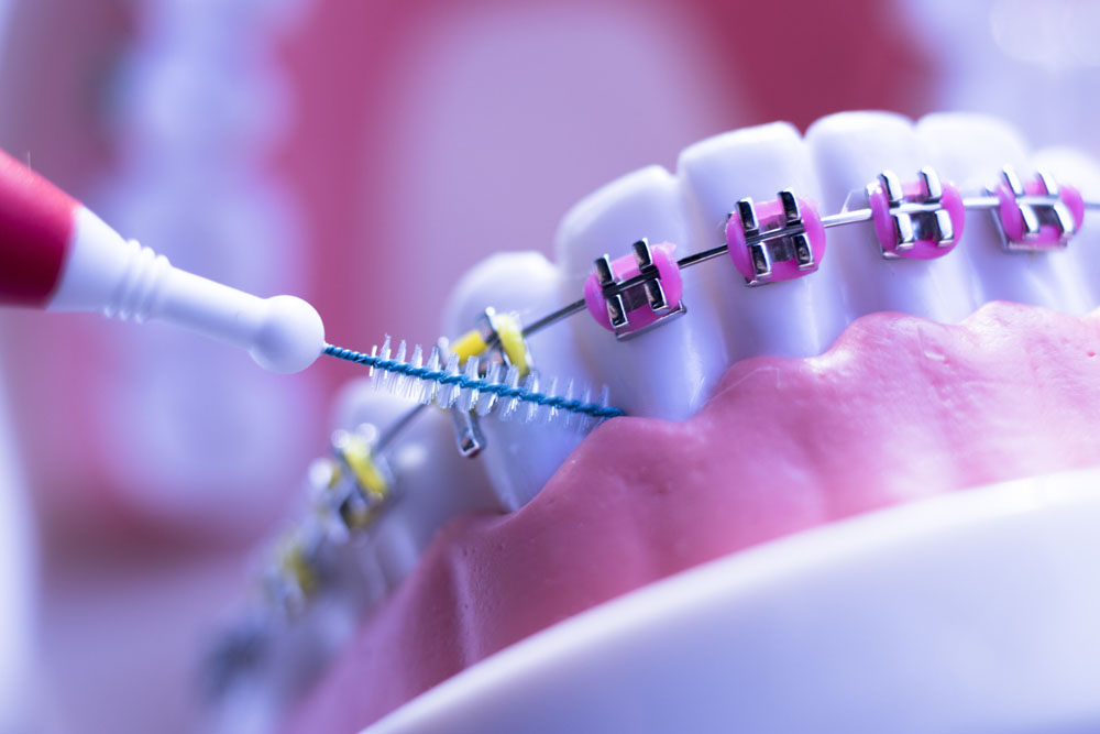Recommendations for bracket care