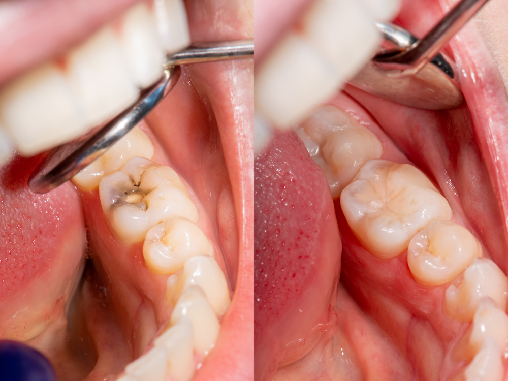 Caries dentales en Panamá