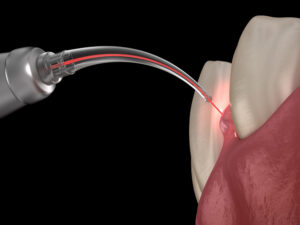 Frenectomía dental en Panama