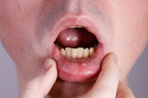 Mucocele Surgery in Panama