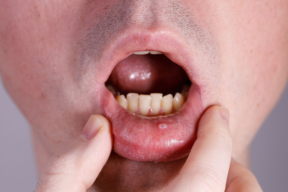 Mucocele Surgery in Panama