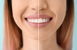 Gingivoplastia en Panama