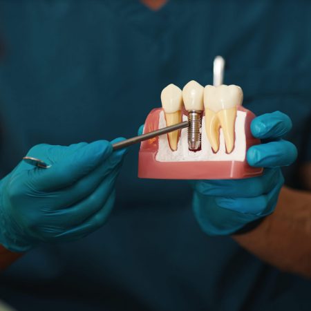 Dentista sosteniendo imlante dental_Clinica Dental Champsaur